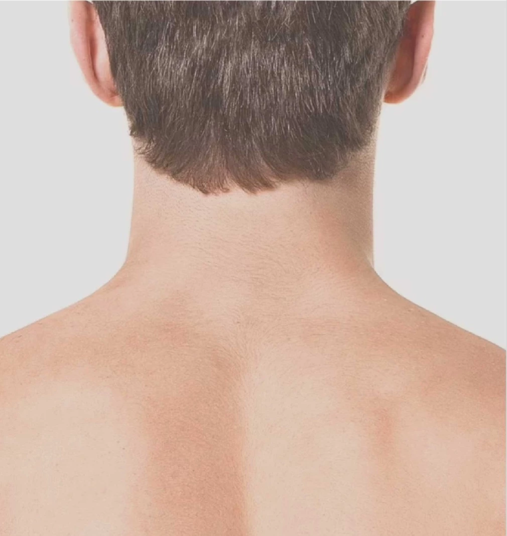 Depilación Láser Cuello Posterior hombre